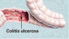 Fekélyes vastagbélgyulladás (colitis ulcerosa) ( 17 ) | Dr. Varga Patrícia