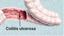 A crohn betegség mindig súlycsökkenést okoz e, A colitis ulcerosa tünetei